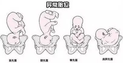 玛丽亚“中医疗法”能转胎位 胎位不正能通过调整实现顺产